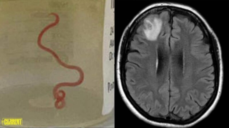Live worm found in woman’s brain during MRI scan