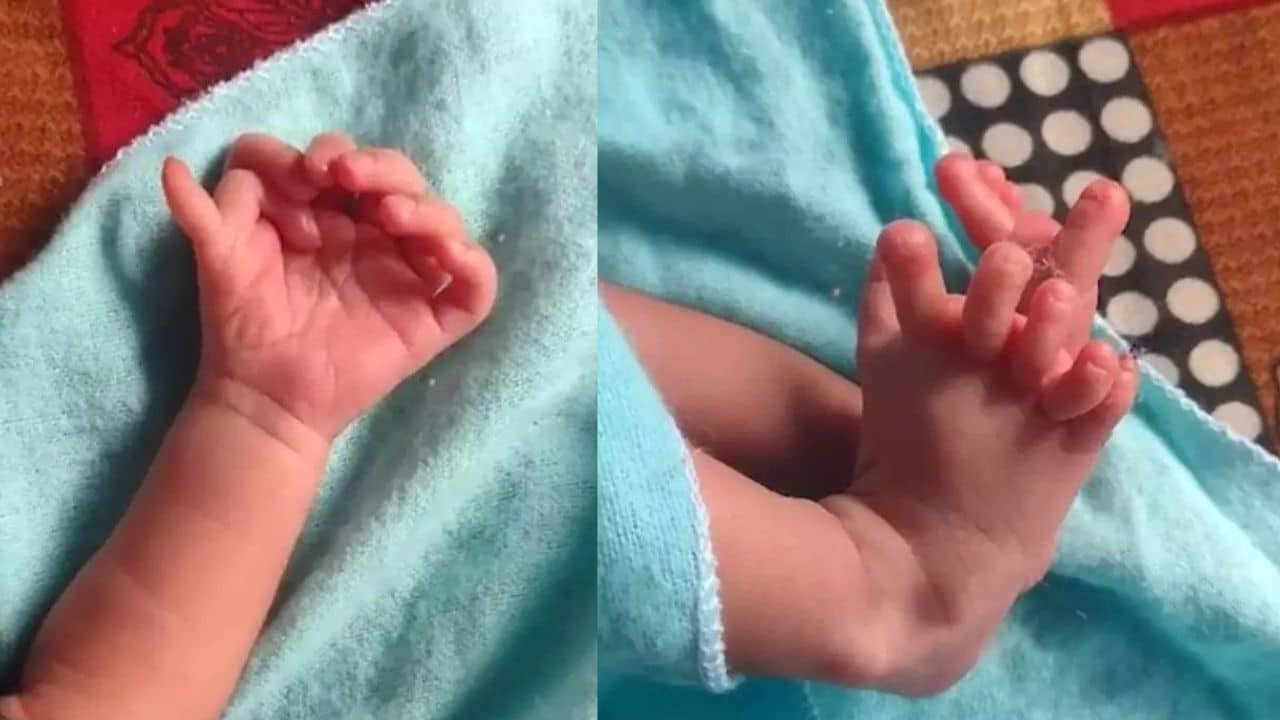Baby girl born with 26 fingers and toes in India