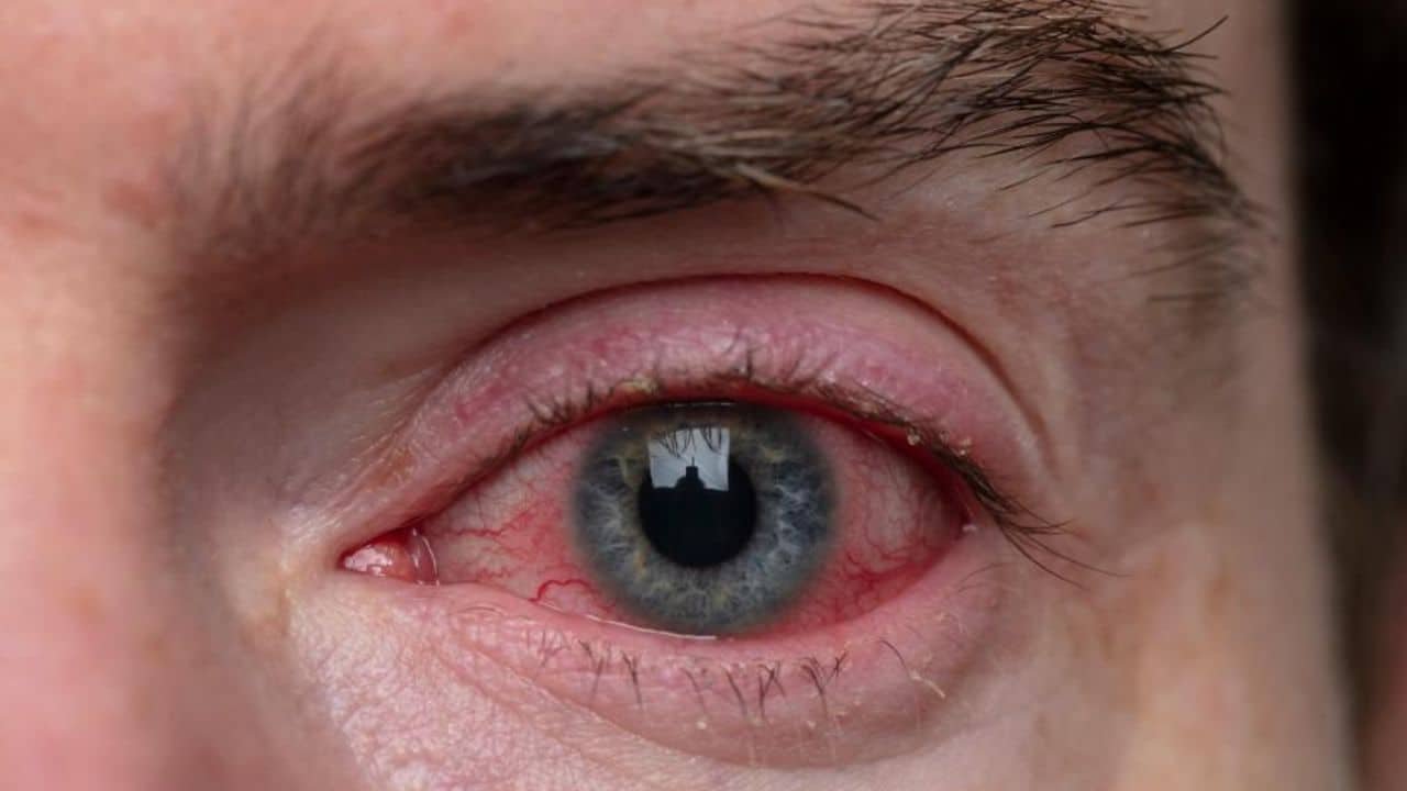Increase in Pink Eye cases; IHRA releases SOPs
