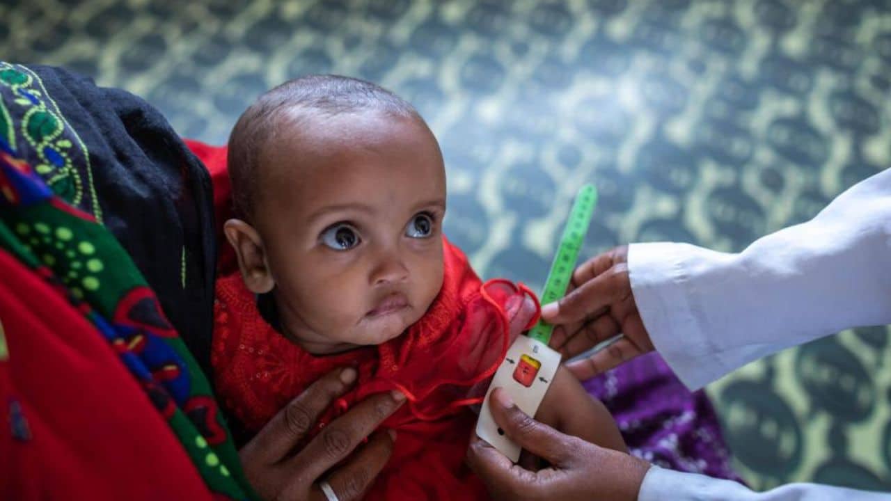 40% children in Pakistan suffer from malnutrition