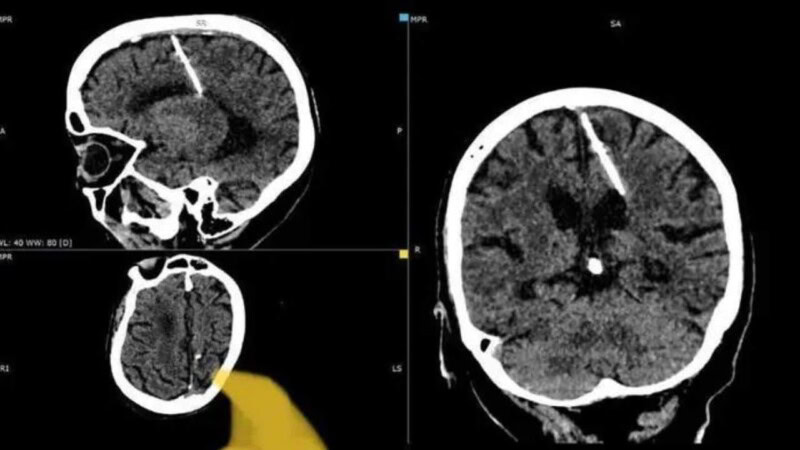Russian woman lived with needle in brain for 80 years