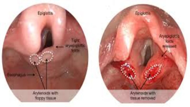 What Is Laryngomalacia? Symptoms, Causes, and Treatments