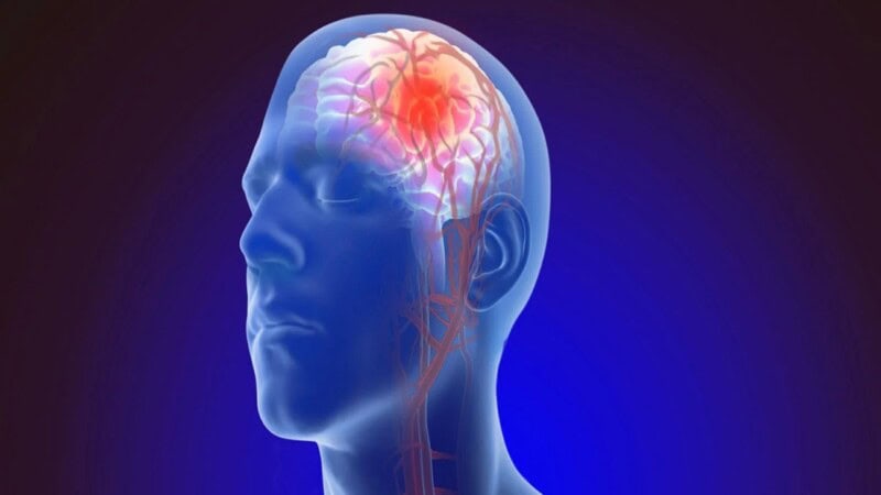 Brain Aneurysm: Everything You Need to Know to Stay Safe
