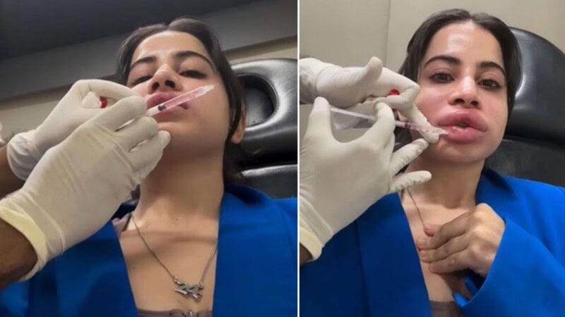 ‘This is not a filter’: Urfi Javed reveals painful reason behind removing lip fillers