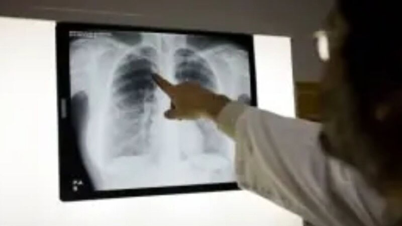 WHO says TB kills 140 people in Pakistan every day