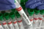 Karachi hospital sealed after infant contracts mpox after circumcision