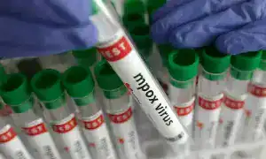 Karachi hospital sealed after infant contracts mpox after circumcision